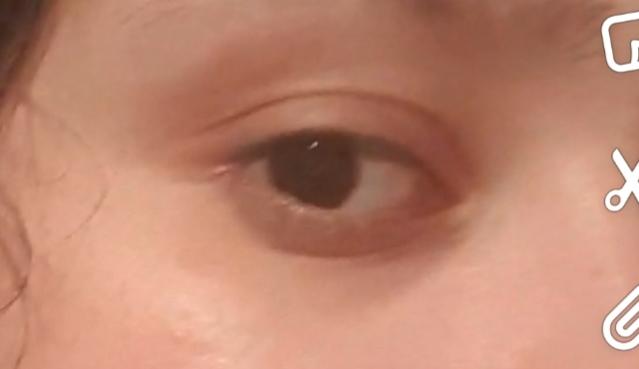 Anyone know how to get rid of this horrible discoloration on my eyelids?