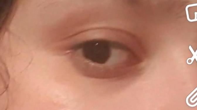 Anyone know how to get rid of this horrible discoloration on my eyelids?
