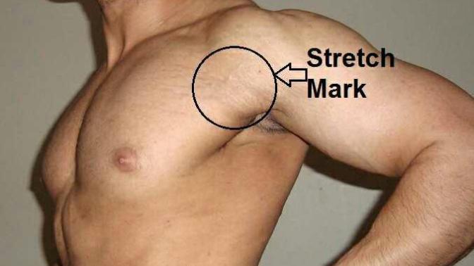 Is it possible to get rid of stretch marks?