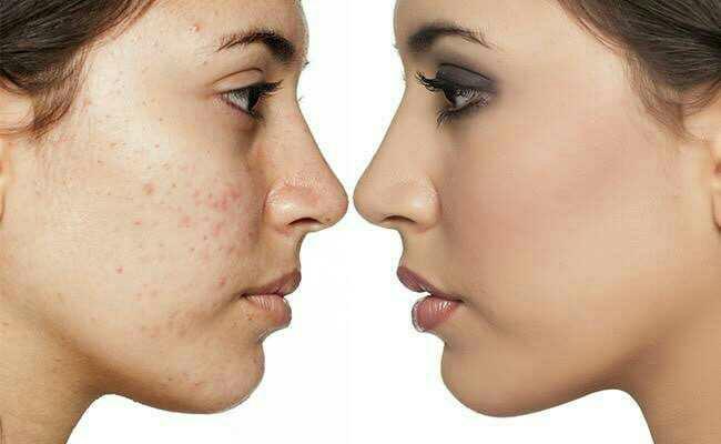 Do you have acne on face or have acne free face?