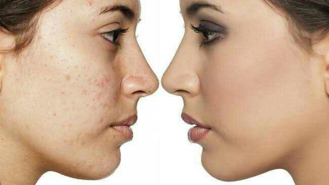 Do you have acne on face or have acne free face?