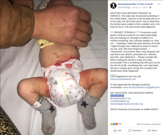 US baby boy almost killed because of circumcision, when will it end?