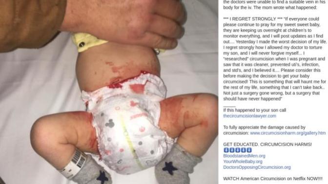 US baby boy almost killed because of circumcision, when will it end?