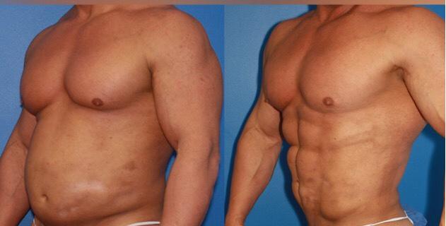 Would You Date Someone Who’s Had Surgery To Make Their Body Look Better? Lipo, Tummy Tuck, Plastic Surgery Etc?