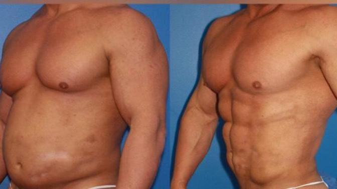 Would You Date Someone Who’s Had Surgery To Make Their Body Look Better? Lipo, Tummy Tuck, Plastic Surgery Etc?