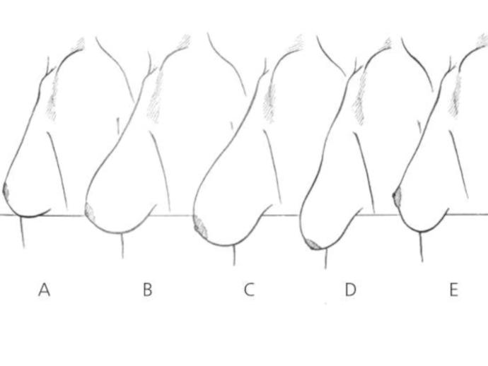 Are any of these ptosis stages not unattractive?