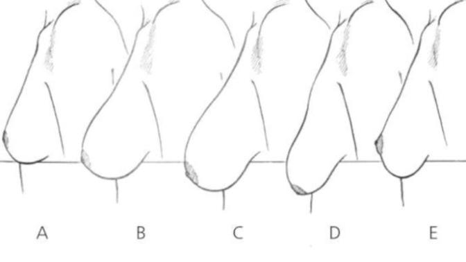 Are any of these ptosis stages not unattractive?