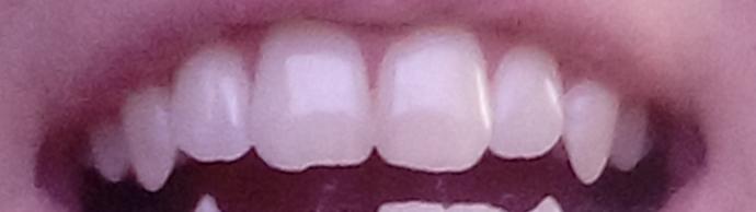Can you have plastic surgery to get vampire-like fangs?