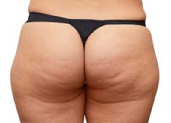 Why do I have cellulite on my buttocks?
