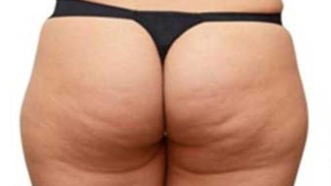 Why do I have cellulite on my buttocks?