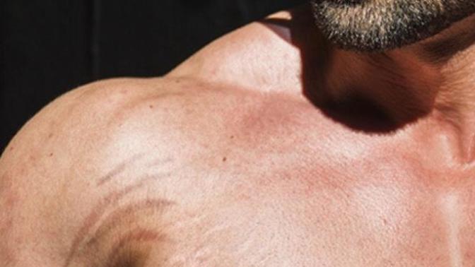 Do You Have Stretch Marks? How Can I Avoid Them While Going Through Puberty? Is That Possible?
