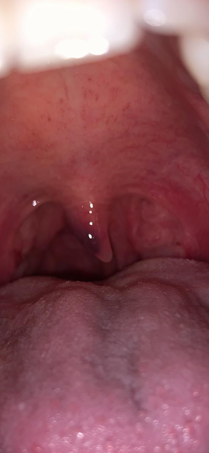 Why is my throat vulva purple? it also feels swollen and is hard to swallow abit. urgent need to know what it is ?