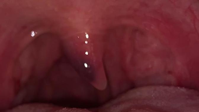 Why is my throat vulva purple? it also feels swollen and is hard to swallow abit. urgent need to know what it is ?