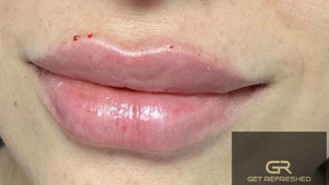 Tips/advice for cosmetic procedures to better my experience (dont brother if ur gonna be judgmental or tell me not to do it idgaf)?