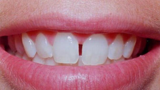 Do you have spaces in your teeth? Do you need to go to the dentist?