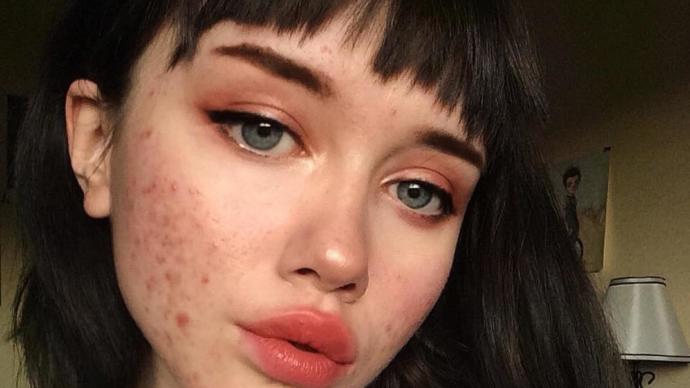 Is acne a turn off?
