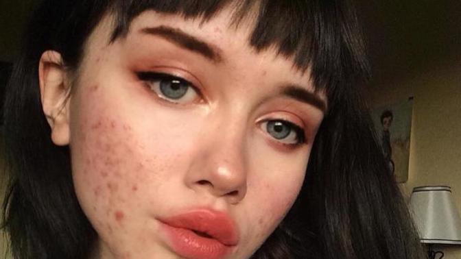 Is acne a turn off?