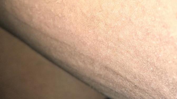 Why are these stretch marks keep appearing and disappearing?