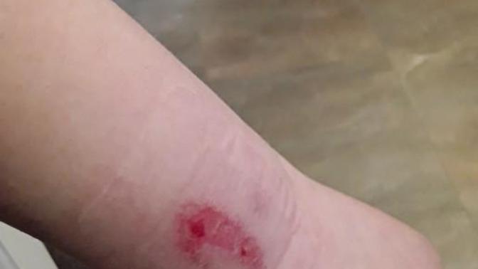 Does this burn look infected?
