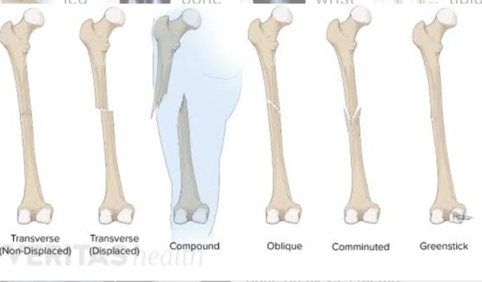 Does broken bones got stronger after it heals?