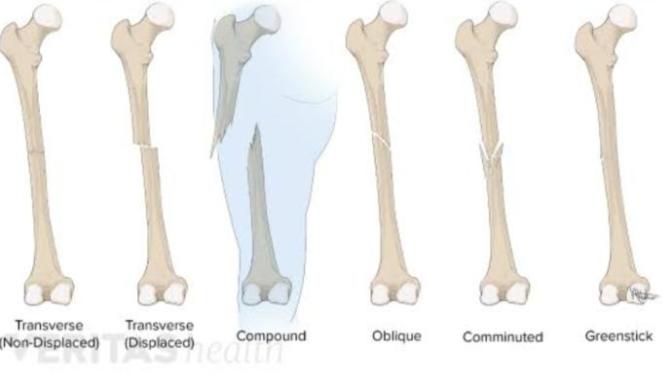 Does broken bones got stronger after it heals?