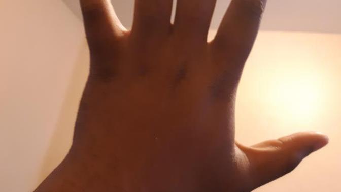 Is my skin light enough for electrolysis?