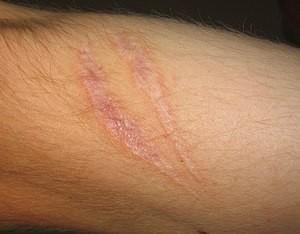 Are scars down there a dealbreaker for you?