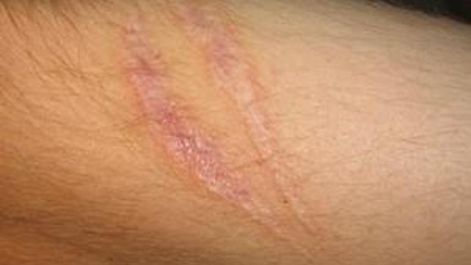 Are scars down there a dealbreaker for you?