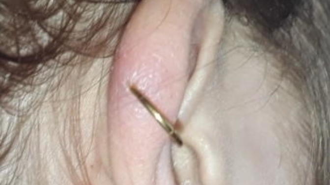 WHY IS MY HELIX PIERCING STILL SWOLLEN?