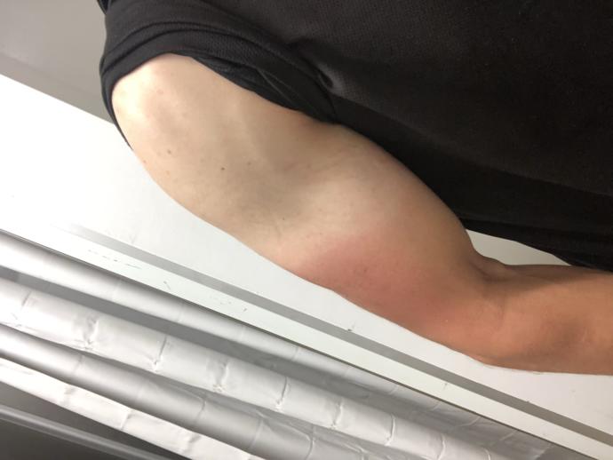 Have you ever gotten a really bad tan line?