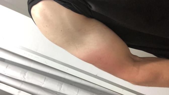 Have you ever gotten a really bad tan line?