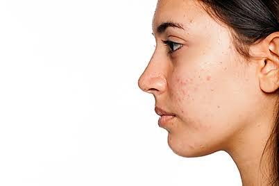 Is acne a deal breaker when it comes to looks?