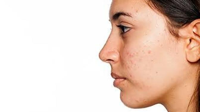 Is acne a deal breaker when it comes to looks?