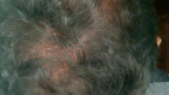 Oily scalp,, how to cure?