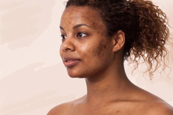 White people, would you rather be bald or have moderate acne (both permanently)?