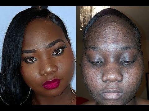 White people, would you rather be bald or have moderate acne (both permanently)?