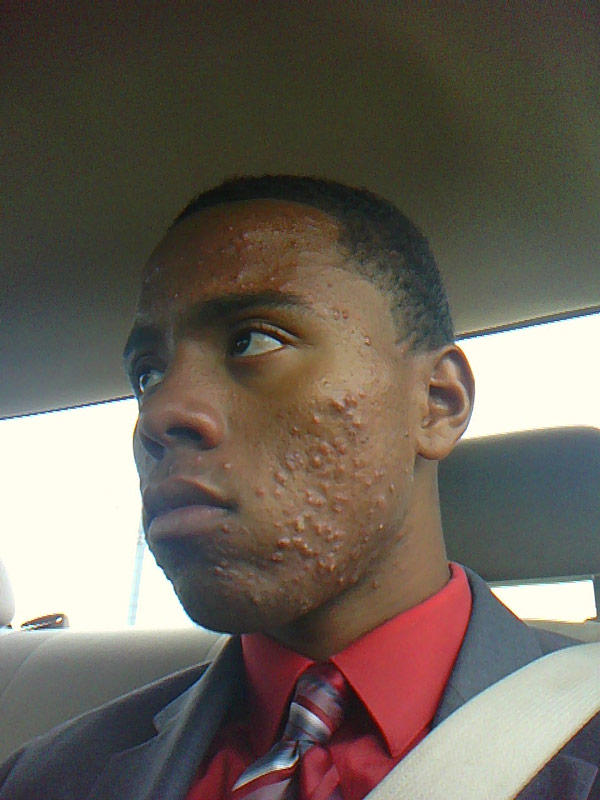 White people, would you rather be bald or have moderate acne (both permanently)?