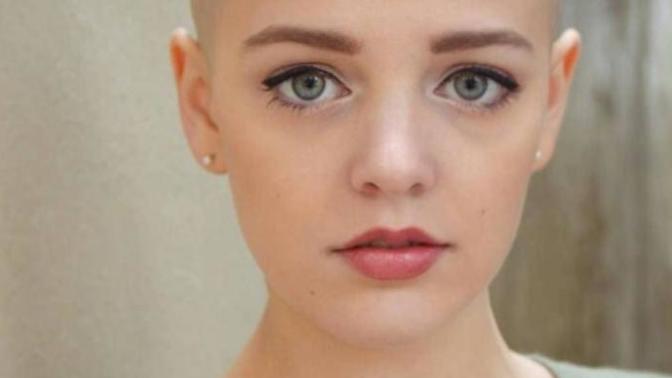 White people, would you rather be bald or have moderate acne (both permanently)?
