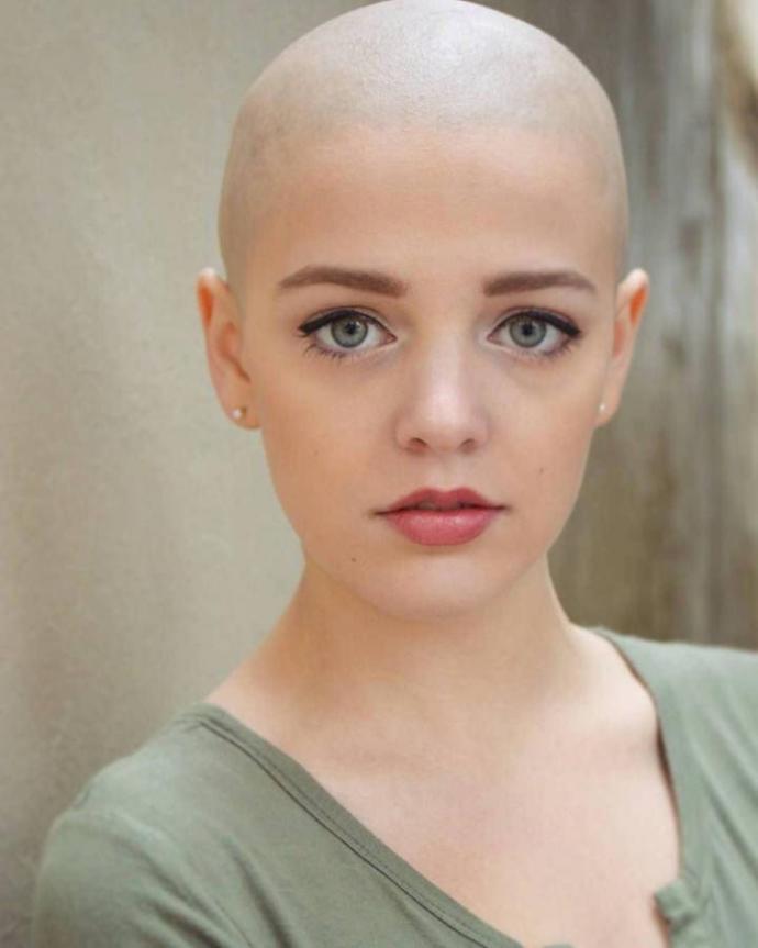 Would you rather date a (white) person of the opposite sex who was bald or who had moderate acne?