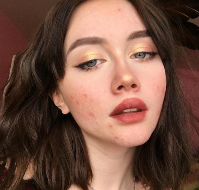 Would you rather date a (white) person of the opposite sex who was bald or who had moderate acne?