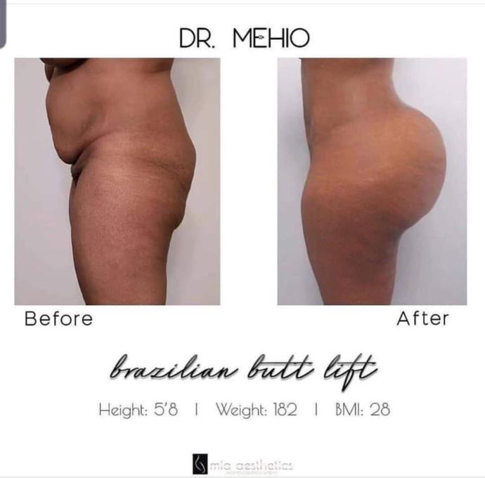 How Do You Feel About Women Getting Body Surgery To Look Better? Would You Date Someone That Had Body Plastic Surgery To Look Better?