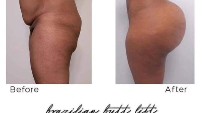 How Do You Feel About Women Getting Body Surgery To Look Better? Would You Date Someone That Had Body Plastic Surgery To Look Better?