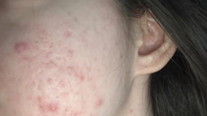 How do I get rid of extremely stubborn acne?