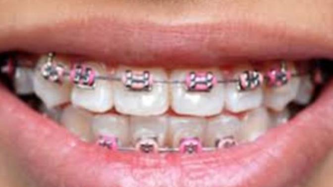 Do You Find Braces Unattractive?