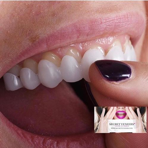 Would you try secret veneer?