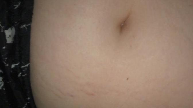 How bad are my stretch marks?