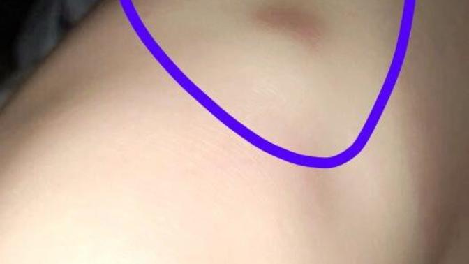 Help! What should I do about my Osgood Schlatters?