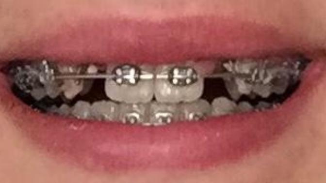Do you think guys will like me having a smile like this? lol?
