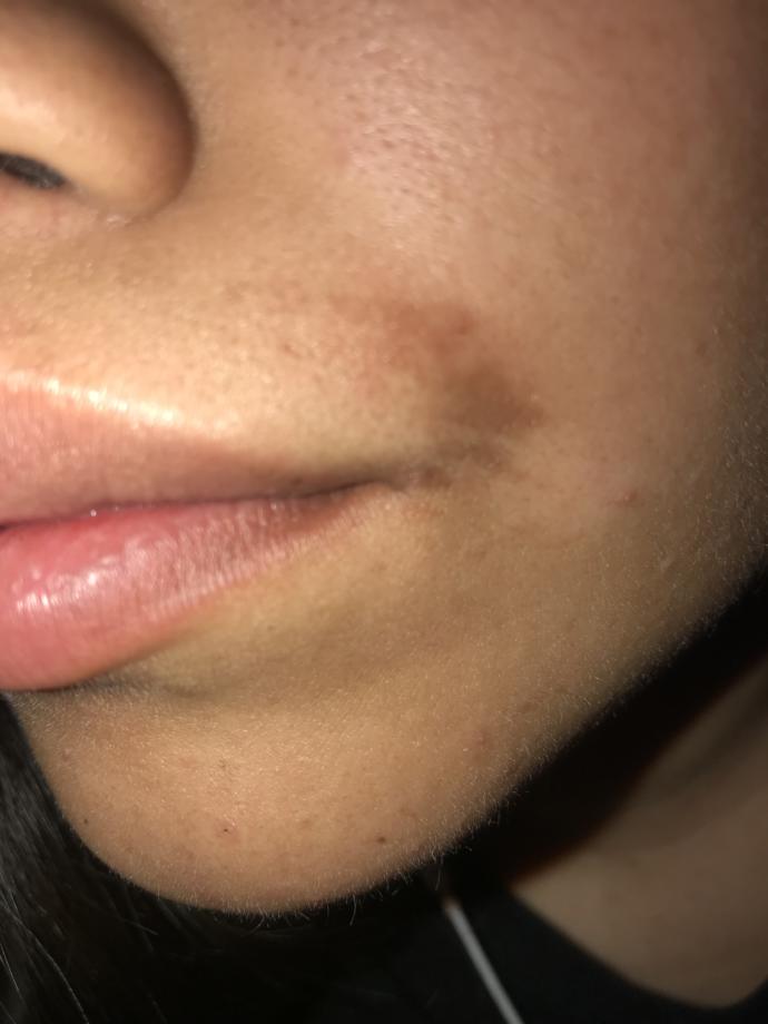 Ok I posted a post where I burned my lip with some wax strips and I think it’s healing but will this take off if yes how long?