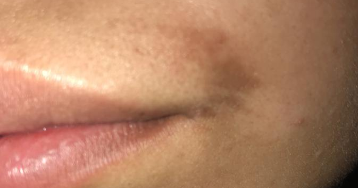 Ok I posted a post where I burned my lip with some wax strips and I